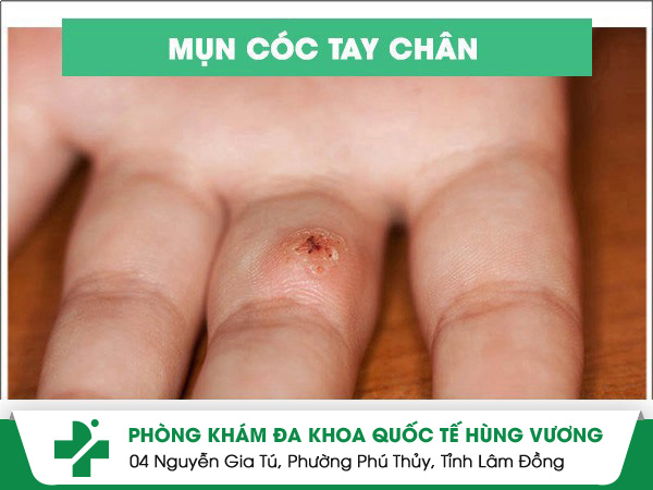 Chữa mụn cóc tay chân như thế nào hiệu quả?