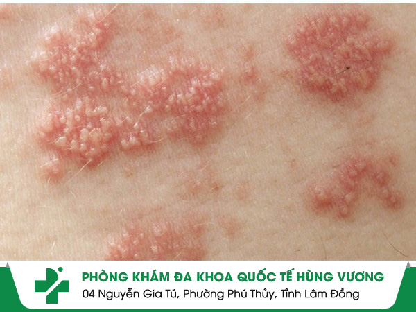 Mụn nước mông và cách điều trị hiệu quả