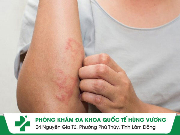 Mụn Nước Ngứa – Dấu Hiệu Cảnh Báo Nhiều Bệnh Nguy Hiểm!