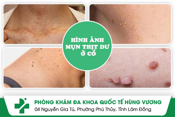 Mụn thịt dư ở cổ: Nguyên nhân và cách điều trị hiệu quả, an toàn