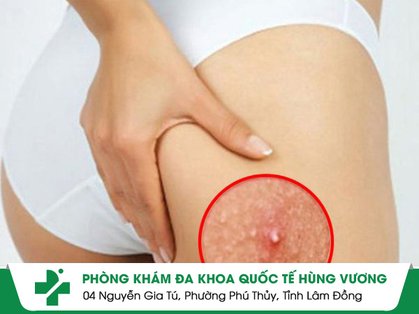 Mụn viêm mông và cách khắc phục hiệu quả