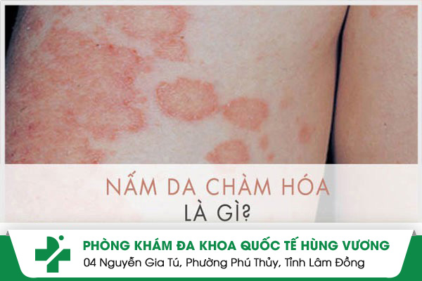 Nấm chàm hóa là gì? điều trị bằng cách nào hiệu quả?
