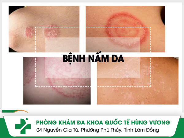 Các bệnh nấm da thường gặp và cách điều trị hiệu quả