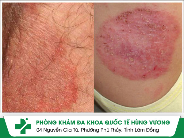 Hình ảnh bệnh nấm háng. nấm háng