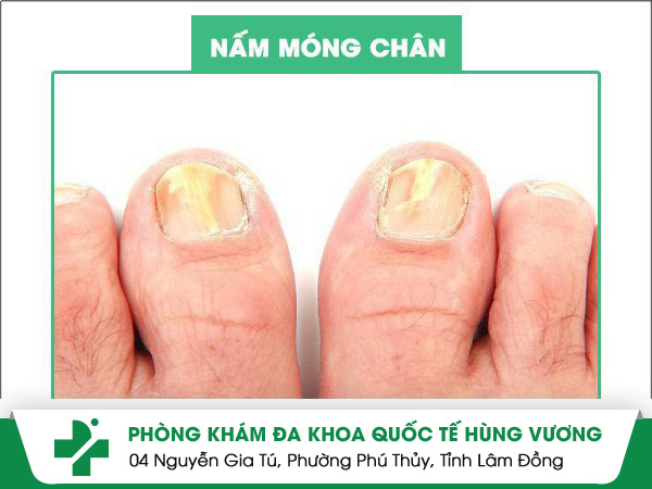 Nấm móng chân nguyên nhân và cách điều trị