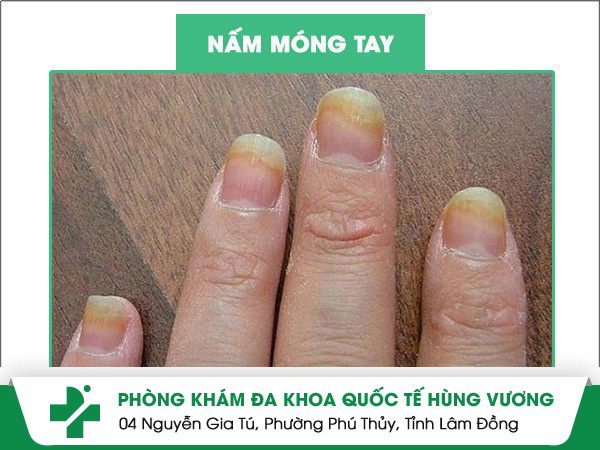 Nấm móng tay là bệnh gì?
