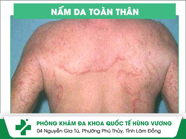 Nấm toàn thân nguyên nhân do đâu?