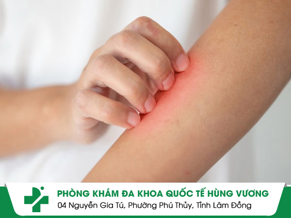 Ngứa Da, Nổi Mẩn Ngứa – Nguyên Nhân, Biến Chứng Và Cách Điều Trị An Toàn