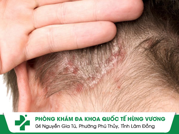 Ngứa Da Đầu – Dấu Hiệu Không Chỉ Là Gàu, Cảnh Báo Nhiều Bệnh Lý Nguy Hiểm