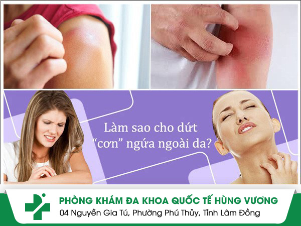 Ngứa Ngoài Da – Đừng Coi Thường Triệu Chứng Nhỏ!