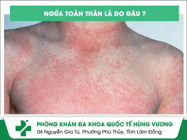 Ngứa toàn thân cảnh báo bệnh gì, điều trị như thế nào?