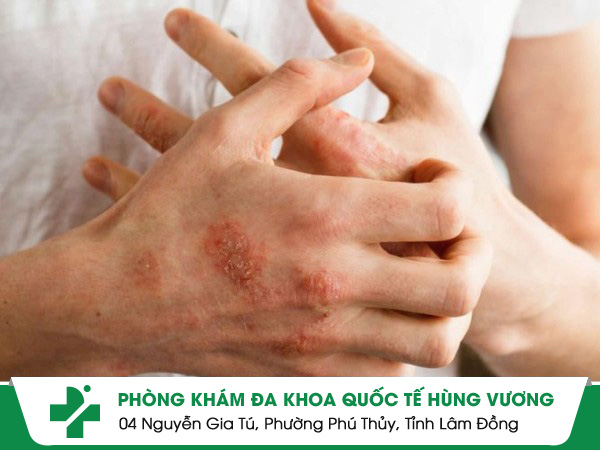 Ngứa Nổi Cục Khắp Người Là Bệnh Gì? Cảnh Báo Dấu Hiệu Cơ Thể Đang