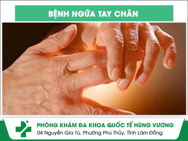 Ngứa Tay Chân –  Triệu Chứng Tưởng Nhẹ, Hậu Quả Không Nhẹ