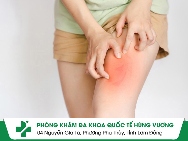 Các yếu tố gây nên tình trạng ngứa toàn thân