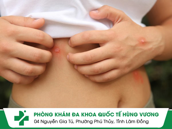 Cẩn Trọng: Da Nổi Ngứa Từng Mảng Có Thể Gây Biến Chứng Nặng