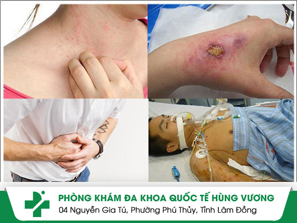 Nguy hại cần hết sức cảnh giác khi bị viêm da dị ứng