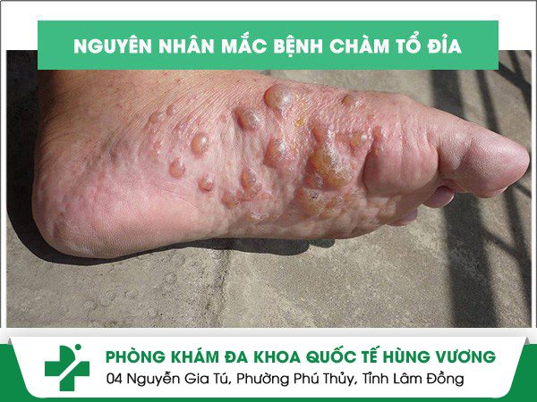 Nguyên nhân gây bệnh chàm tổ đỉa là do đâu?