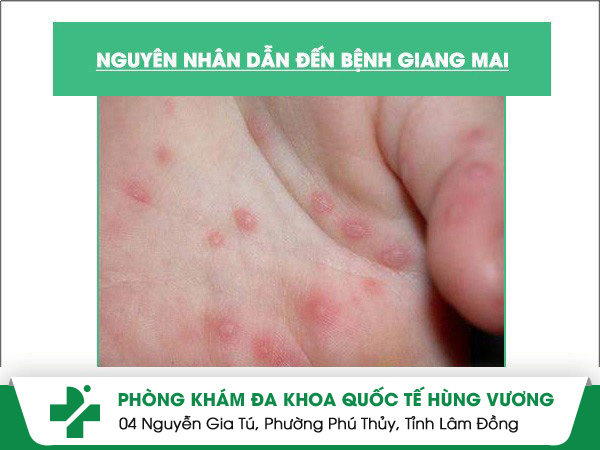 Các nguyên nhân dẫn đến bệnh giang mai