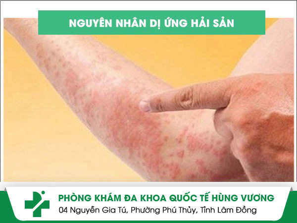 dị ứng hải sản