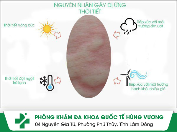 Nguyên nhân gây dị ứng thời tiết người bệnh cần chú ý
