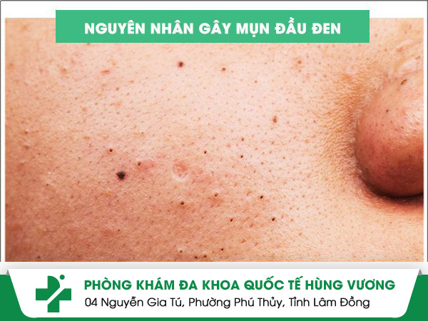 Nguyên nhân gây mụn đầu đen hay gặp ở nhiều người