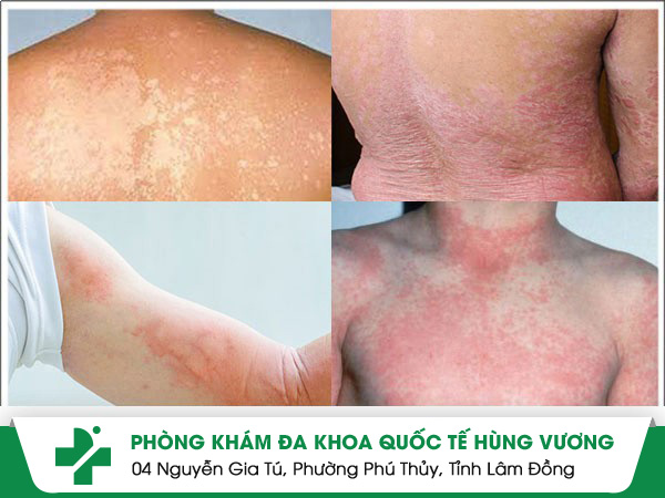 Bất ngờ với nguyên nhân gây ngứa khắp người