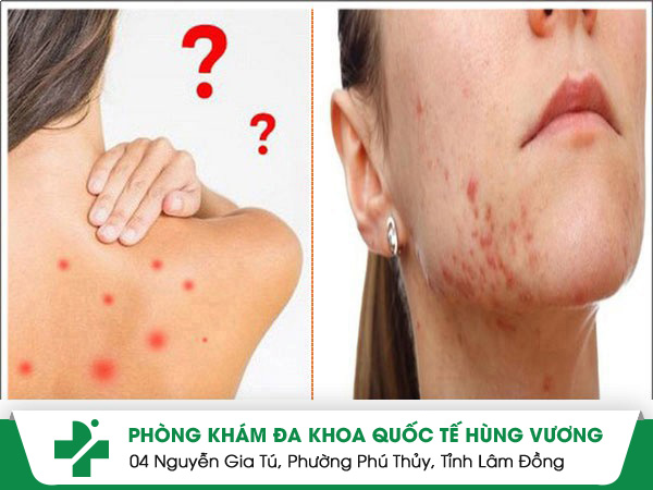 Nguyên nhân gây mụn ngứa người bệnh cần nắm rõ