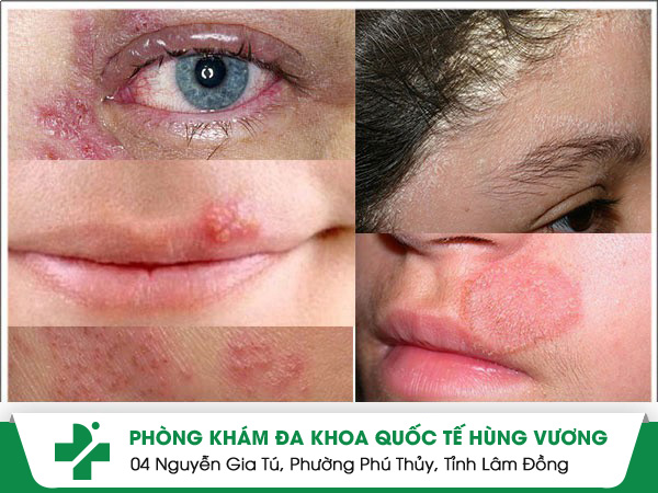 Nguyên nhân ngứa mặt thường xuyên không thể bỏ qua