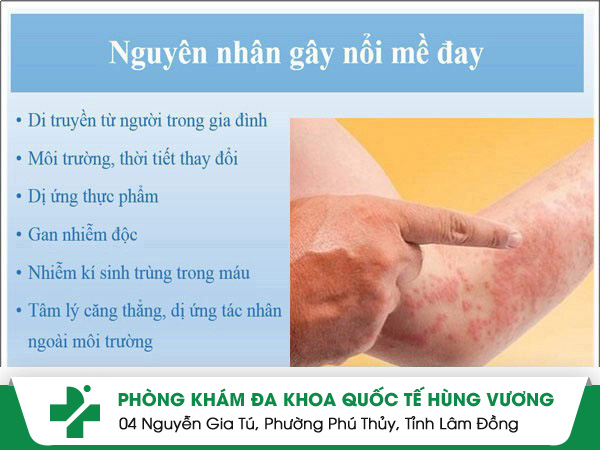 Đi tìm nguyên nhân nổi mề đay và cách điều trị thích hợp