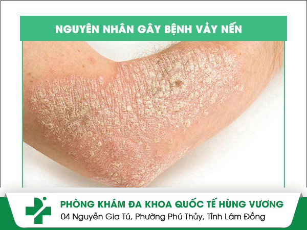 Nguyên nhân mắc bệnh vảy nến ở nhiều người