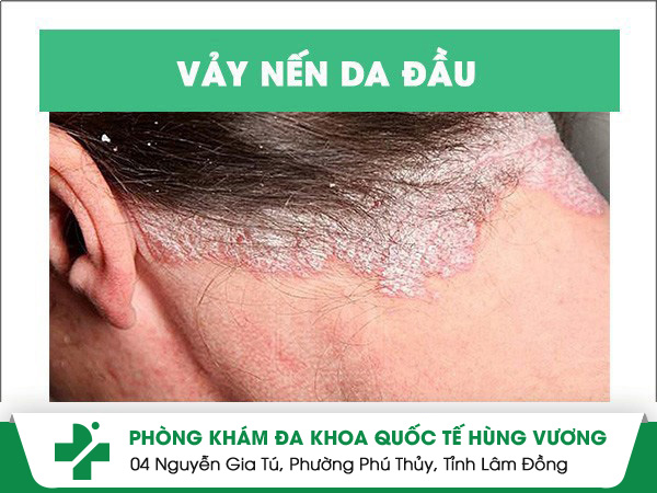 Nguyên nhân gây ra vảy nến da đầu