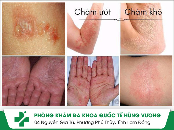Nhận diện triệu chứng bệnh chàm ác mộng của nhiều bệnh nhân