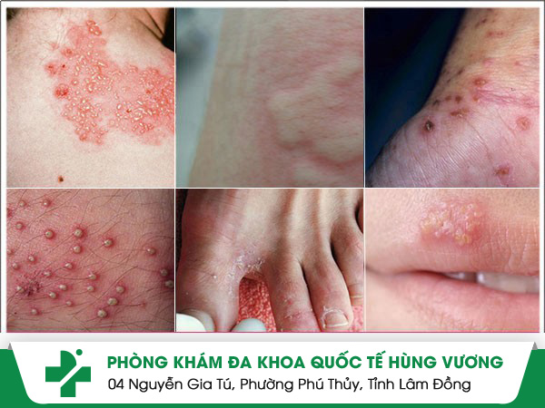 Những bệnh da liễu thường gặp ở mùa mưa bạn cần biết