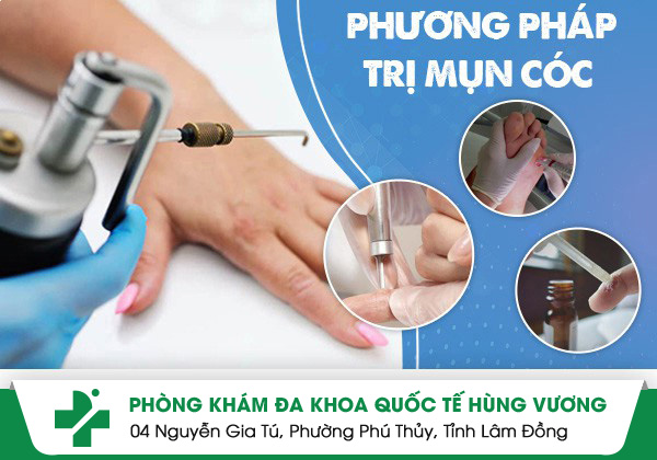 Những cách trị mụn cóc hiệu quả hiện nay