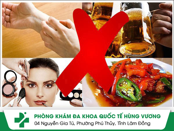 Những lưu ý khi mắc mề đay người bệnh nên biết