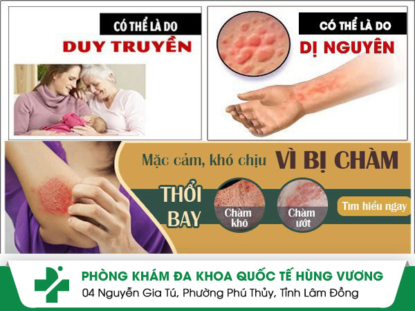Những nguyên nhân chính gây bệnh chàm mà bạn không ngờ tới