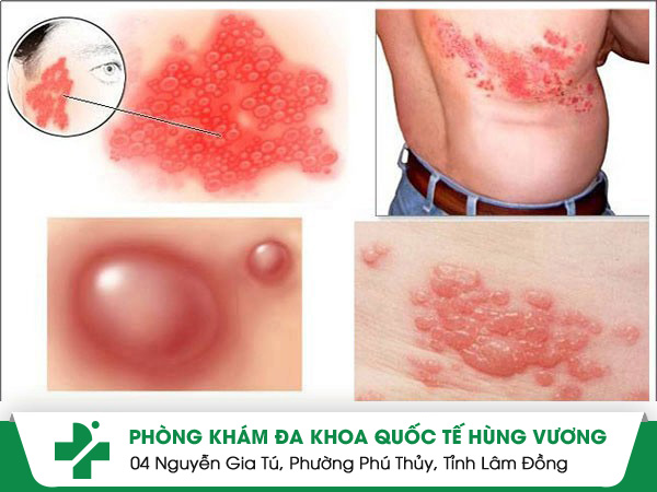 Những nguyên nhân gây bệnh Zona điển hình mà bạn cần biết