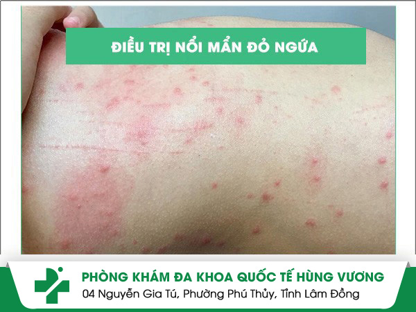 Điều trị nổi mẩn đỏ ngứa nhanh chóng - hiệu quả