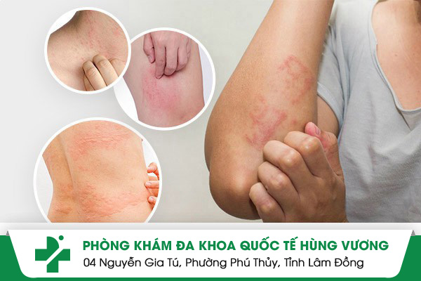 Bệnh Mề Đay – Bệnh Ngoài Da Tưởng Nhẹ Mà Hóa Nguy Hiểm!