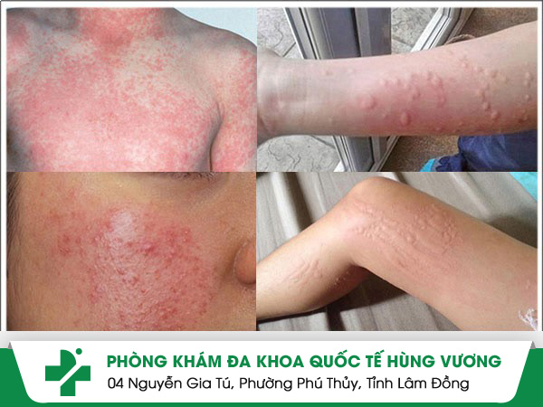 Cách chữa dị ứng với quần áo hiệu quả