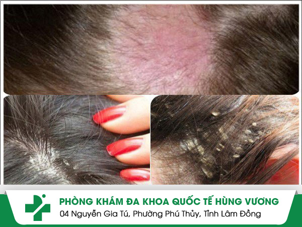 Nấm Da Đầu: Đừng Xem Thường Những Dấu Hiệu Nhỏ!