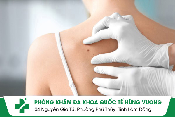 Phòng khám da liễu huyện Bình Chánh nào mang lại hiệu quả?