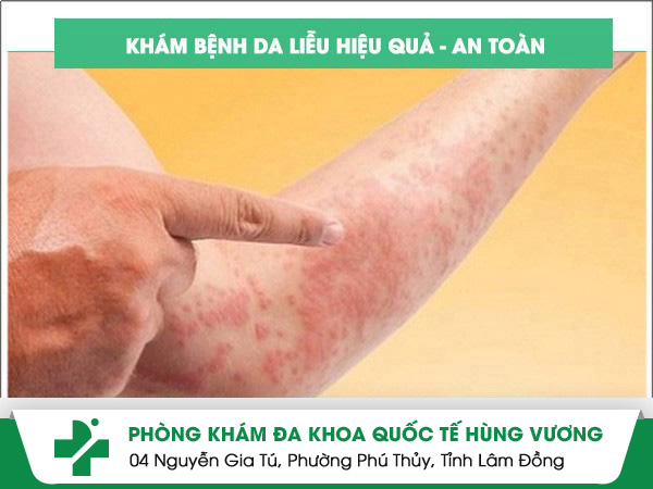 Khám Da Liễu Quận 7: Dấu Hiệu, Chi Phí & Địa Chỉ Uy Tín Nên Đến Sớm