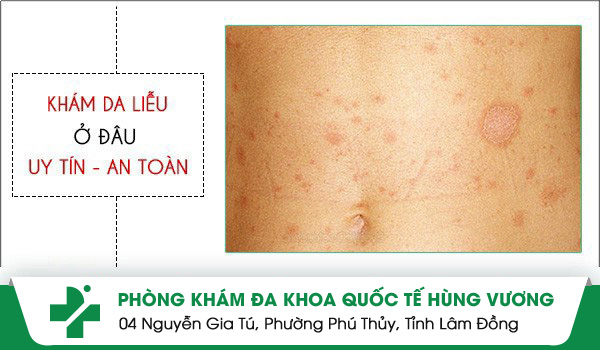 Phòng Khám Da Liễu Quận 9 Uy Tín - Chất Lượng