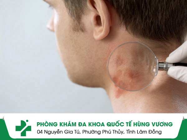 Khám Da Liễu Ở Bà Rịa – Vũng Tàu: Nên Chọn Địa Chỉ Nào Phù Hợp?