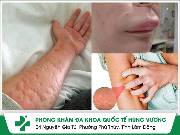 Bệnh phong lạnh là gì? Làm thế nào để điều trị?