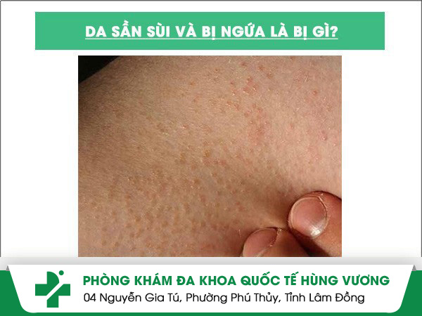 Da sần sùi và ngứa là bị gì nguyên nhân và cách điều trị?