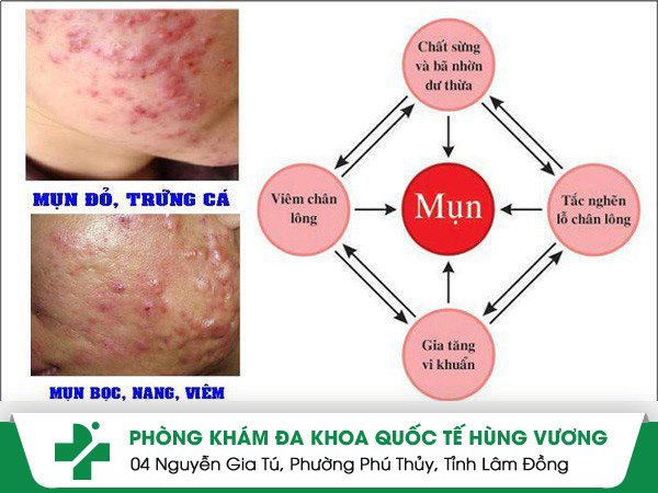 Sưng mụn và cách điều trị hiệu quả bạn đã biết chưa?