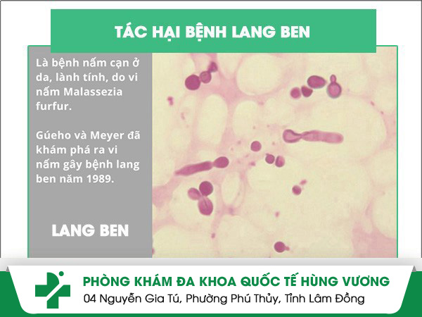 Tác hại của lang ben - những điều cần biết về bệnh