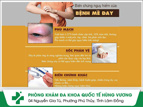 Tác hại nổi mề đay cực nguy hiểm chớ nên xem thường